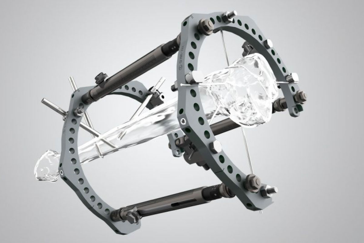 Limb Reconstruction Dr Franz Birkholtz Orthopeadic Surgeon Stellenbosch