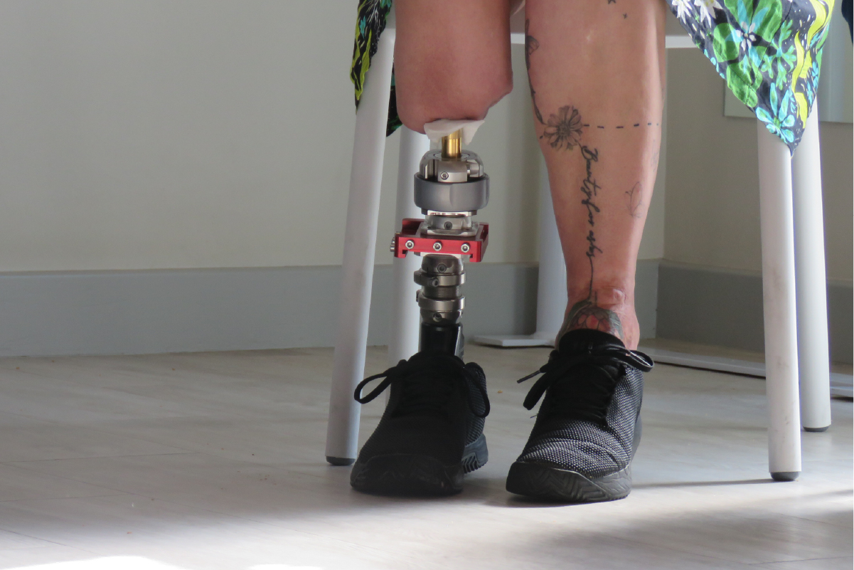 Osseointegration Dr Franz Birkholtz Orthopeadic Surgeon Stellenbosch